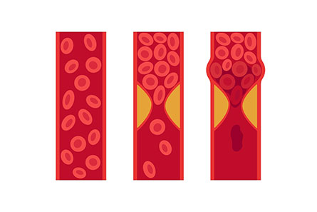 DVT blood clot treatment in Vijayawada