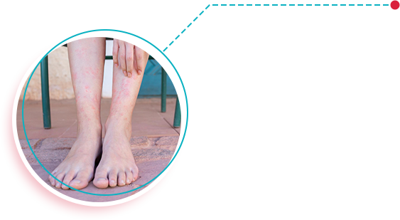 Ulcers on Legs